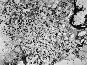 M,63y. | adrenal - neuroblastoma M,63y. | adrenal - neuroblastoma